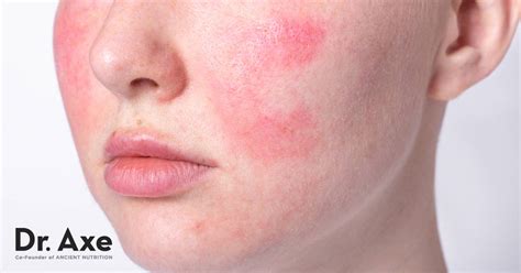 Rosacea Treatment 6 Natural Remedies To Use Dr Axe
