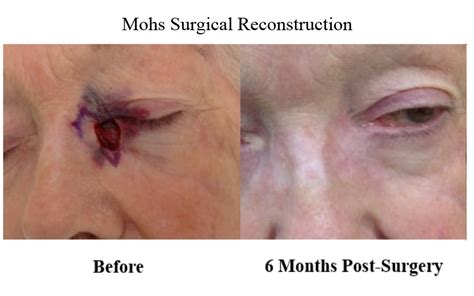 Mohs Surgery Maryland Md Dermatology Mohs Surgery Cosmetic Surgical