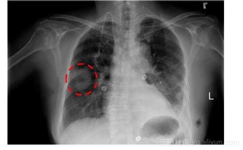【3万患者11万图像14类病理】nih公开大规模胸部x光数据集 阿里云开发者社区