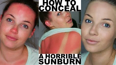 How To Cover Conceal An Awkward Facial Sunburn Youtube