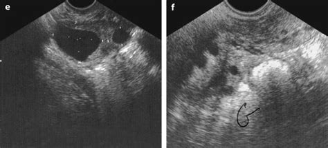 Functional Lesions Of The Ovary Radiology Key