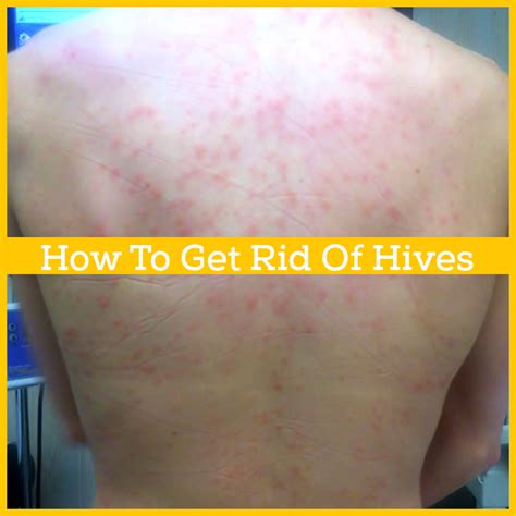How Do You Get Rid Of Hives Healthrelieving