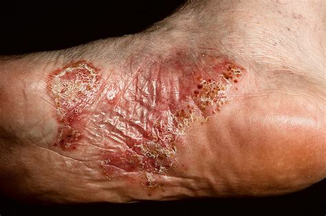 Dyshidrotic Eczema Pictures 48 Photos And Images