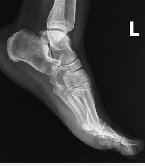 Preoperative Lateral Foot X Ray Image Download Scientific Diagram