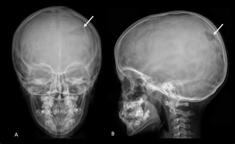 Plain Radiographs Of The Skull Isolated Osteolytic Lesion With
