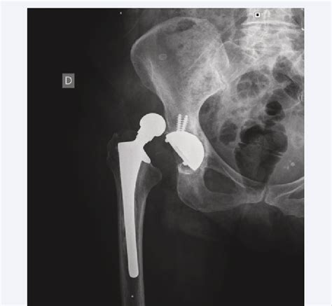 A Preoperative X Ray Of Recurrent Instability Of Total Hip Replacement