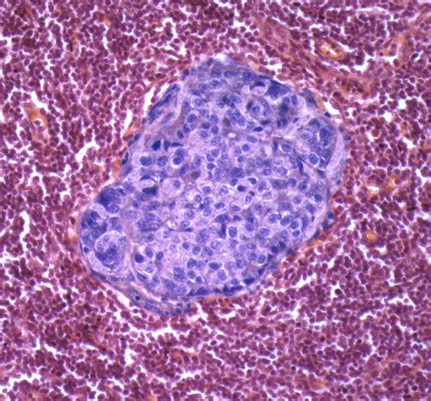 Aged Tissue Implicated As Driver Of Invasive Breast Cancer Inside