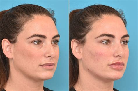 Injectable Fillers Before And After Photo Gallery