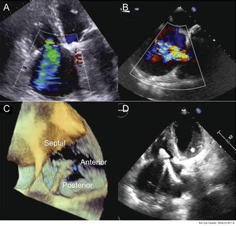 Transcatheter Tricuspid Repair With Mitraclip In A Patient With A
