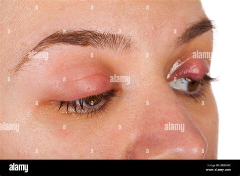 Sty On Eyelid Hi Res Stock Photography And Images Alamy