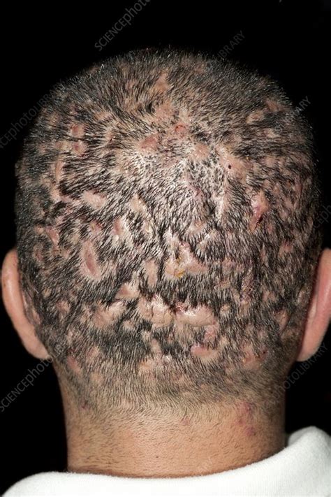 Dissecting Folliculitis On The Scalp Stock Image C0119513