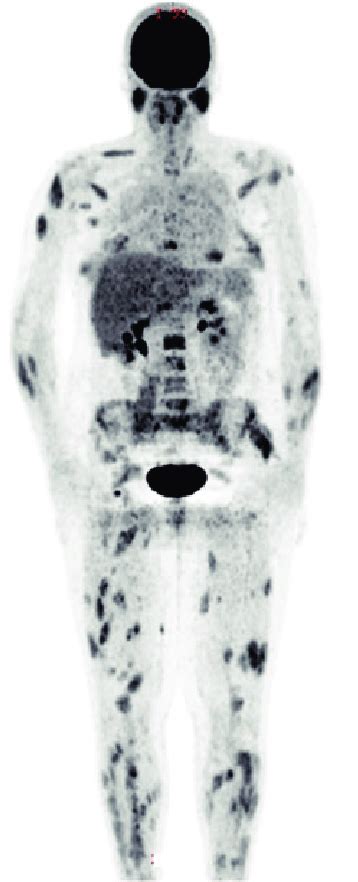 Pet Scan Showing Multifocal Hypermetabolic Activity In A Patient With