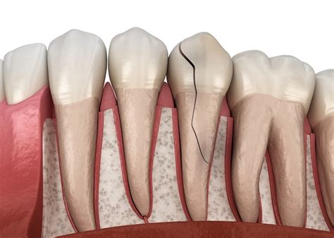 Dental Treatment Options For A Cracked Tooth Columbia Advanced Dental