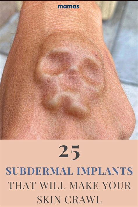 Superb Subdermal Implants That Will Make Your Skin Crawl Subdermal Implants Are Sculpted