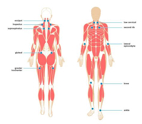 Myofascial Pain Syndrome Nj Spine And Pain Institute