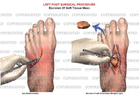 Surgical Excision Of Left Foot Ganglion Cyst — Medical Art Works