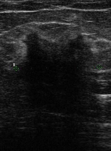 Ultrasound Image Of A Breast Cancer With Irregular Borders Angular