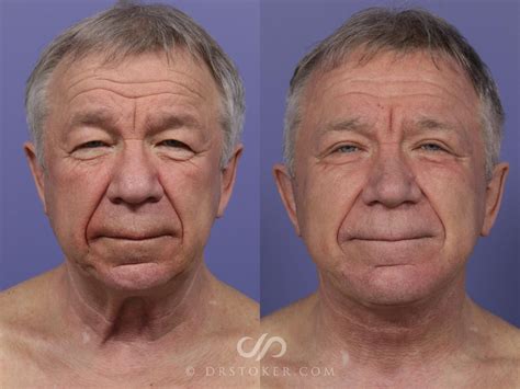 Neck Lift For Men Before And After Photo Gallery Marina Del Rey CA Stoker Plastic Surgery