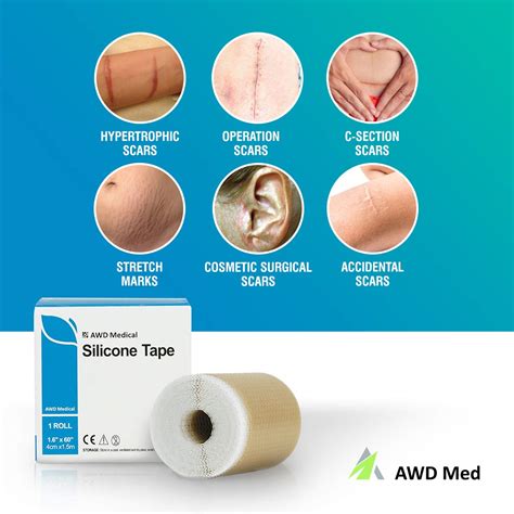 Buy Awd Medical Silicone Scar Sheets Silicone Gel Sheets For Scar