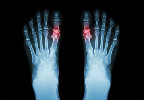 Gout Rheumatoid Arthritis Film X Ray Both Foot And Arthritis At