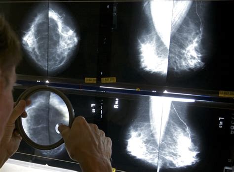 us requires new info on breast density with all mammograms