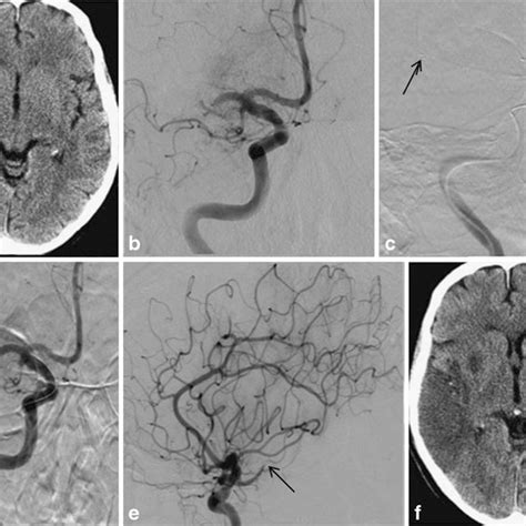 A Ncct Showing Early Ischemic Changes In The Caudate White Arrow