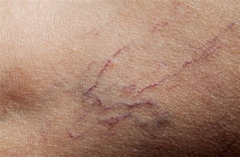 What Are Spider Veins