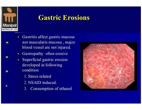 Upper Gi Hemorrhage Surgical Perspective