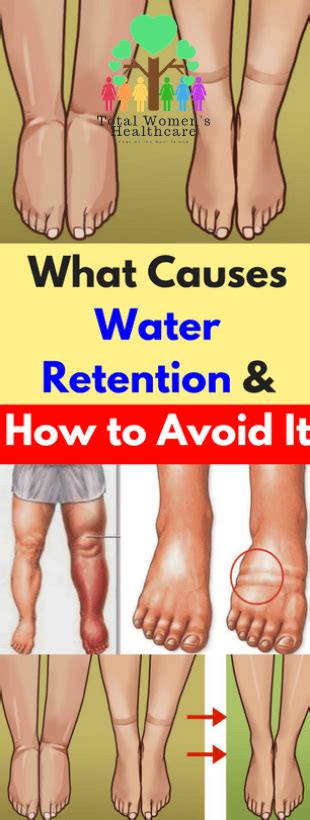 What Causes Water Retention And How To Avoid It Womens Healthy News