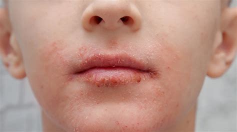 Dry Skin Patches Causes Symptoms And More