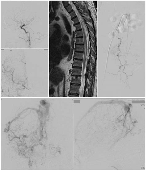 Dural Arteriovenous Fistula Article