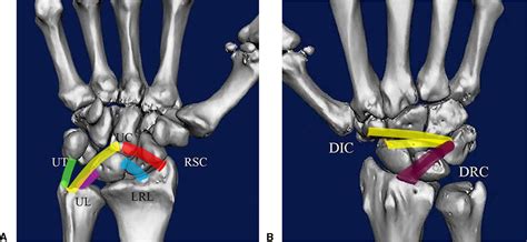 In Vivo Length Changes Of Carpal Ligaments Of The Wrist During Dart