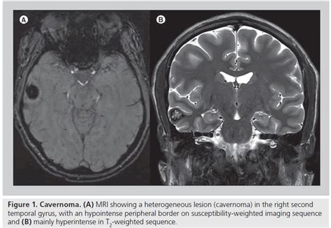 Imaging Techniques For Presurgical Evaluation Of Temporal Lobe Epilepsy