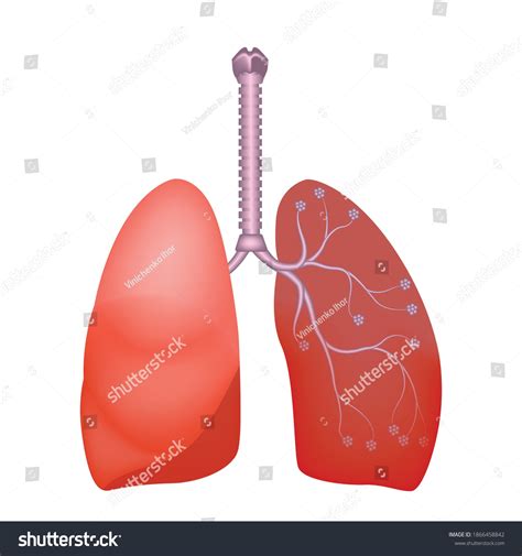 Human Lung Anatomy Lung Abscess Spread Stock Vector Royalty Free