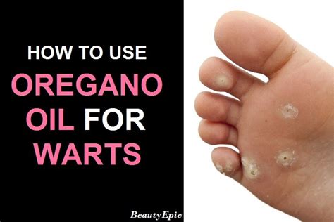 How To Use Oregano Oil For Warts