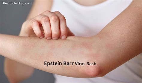 Epstein Varr Virus Rash Definition Symptoms Causes Treatment Pictures