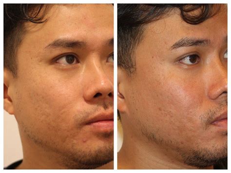 Acne Scar Treatment Co Fractional Laser Skin Resurfacing Infini Scar Treatment
