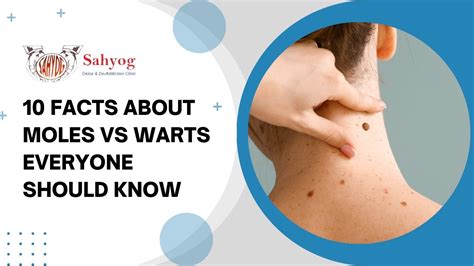 10 Facts About Moles Vs Warts Everyone Should Know Sahyog Clinic