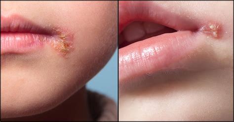 Cold Sores In Babies Causes Symptoms And Treatment