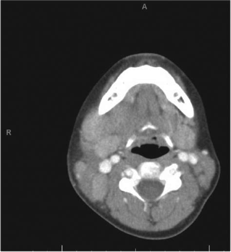 Progressive Unilateral Cervical Lymphadenopathy With Elevated Ldh In A