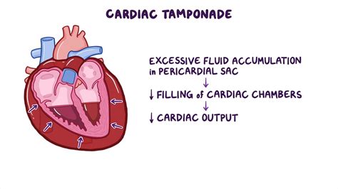 Cardiac Tamponade Symptoms Why Distended Veins