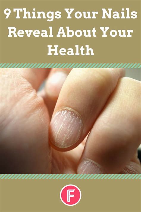 9 Things Your Nails Reveal About Your Health White Lines On Nails