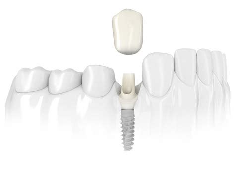 Single Tooth Dental Implants Capital Dental Clinic Fredericton