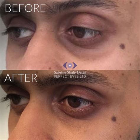 Tear Trough Fillers A Solution To Dark Circles Eye Bags