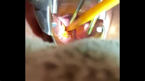 Inserting Foley Into Cervix Xxx Mobile Porno Videos And Movies Iporntvnet