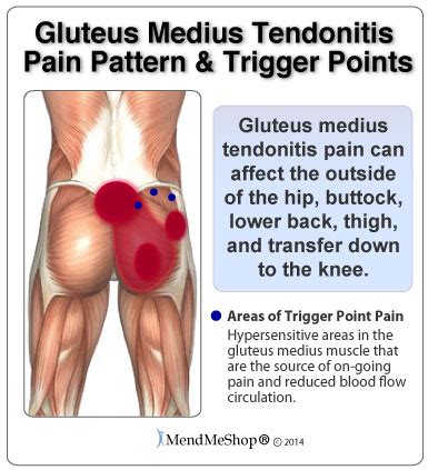 Gluteus Medius Tendinitis