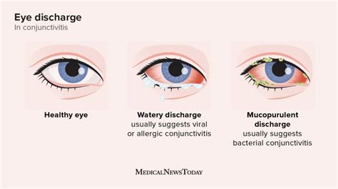 Pink Eye Or Allergies Symptoms And How To Tell