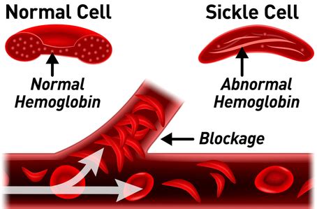 Sickle cell anemia is inherited in an autosomal recessive manner. Sickle Cell Disease | WAGMC