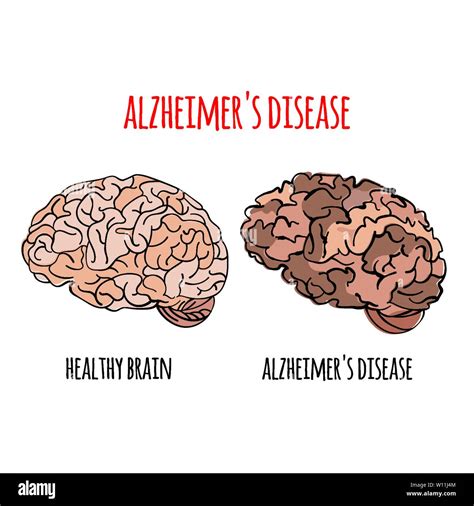 Alzheimer Disease Memory Loss Brain Damage Medicine Health Treatment Therapy Banner Poster