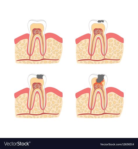 Cartoon Tooth With Stages Of Dental Caries Vector Image